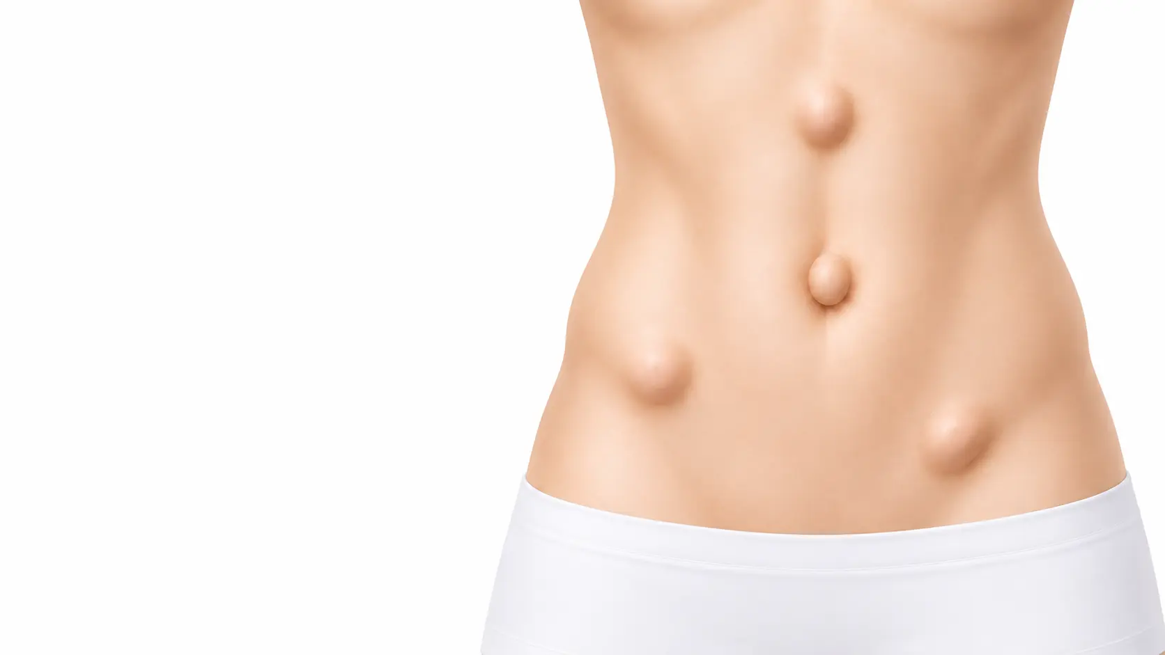 Tipos de hernias abdominales tratadas por el Dr. Ulises Soto en Campeche